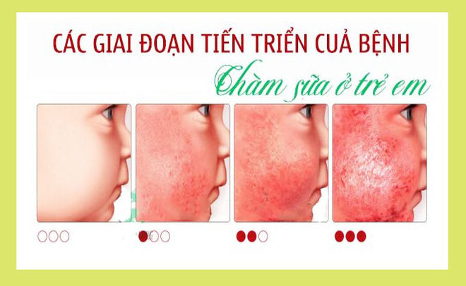 Những tưởng con mắc 4 chứng bệnh về da nhưng sau cùng mẹ thở phào vì bé chỉ bị loại mụn nhẹ này thôi