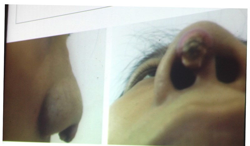 Cô gái 25 tuổi bị biến dạng mũi, đầu mũi lồi ra vì nâng mũi bằng thanh silicon tại spa với giá rẻ. Ảnh: HL.