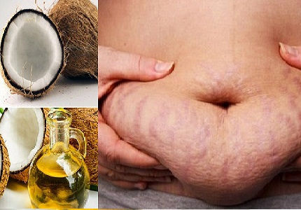 Ngăn ngừa tình trạng rạn da khi mang thai bằng dầu dừa