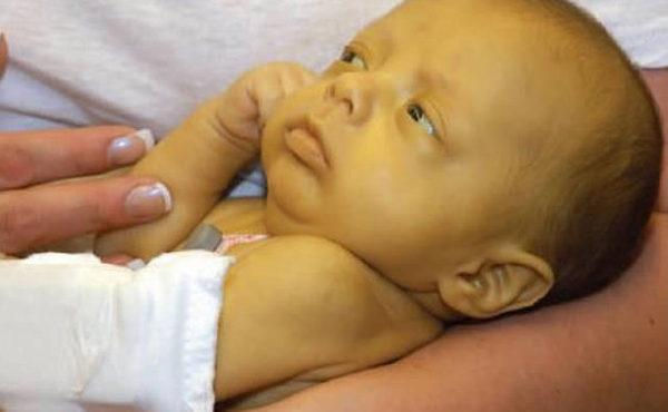 Bệnh vàng da ở trẻ sơ sinh có thể gây ra biến chứng nghiêm trọng khác. (Ảnh minh họa).