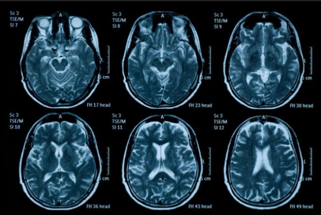 Điện não đồ: Kể từ năm 2013, kỹ thuật đo điện não đồ, một thăm khám đo lường các hoạt động điện và các sóng trong não bộ được đưa vào sử dụng rộng rãi. Đo điện não đồ có thể phát hiện những sóng điện não bất thường trong một số bệnh lý thần kinh, tai biến mạch máu não… Nhờ có công nghệ này, khoảng 04 triệu người được cứu sống mỗi năm.