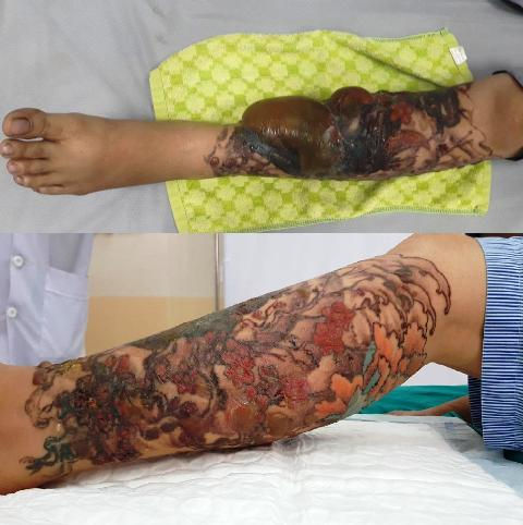    Vết bỏng chân bệnh nhân trước và sau khi được điều trị.  