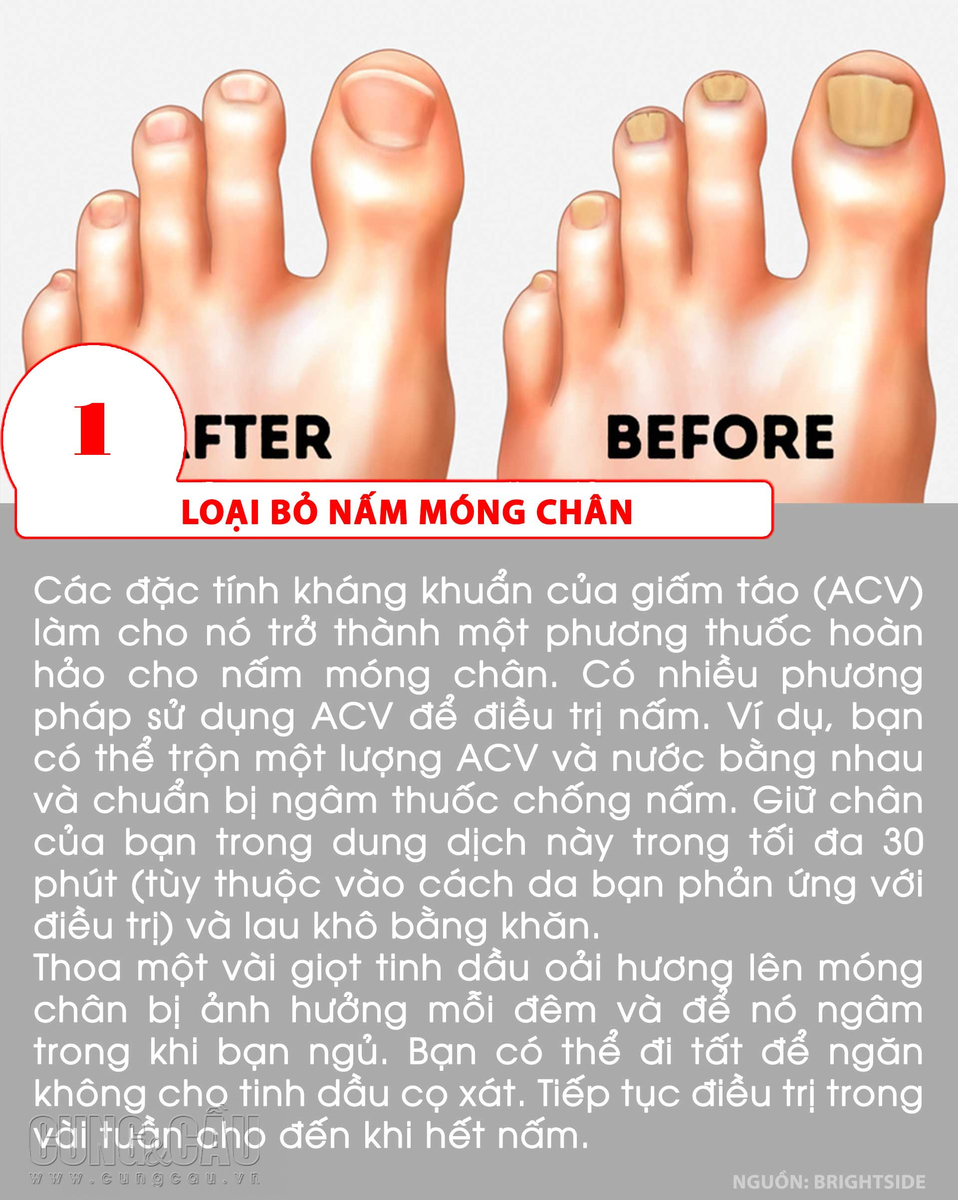 10 cách xử lý để giúp đôi bàn chân của bạn đẹp hơn