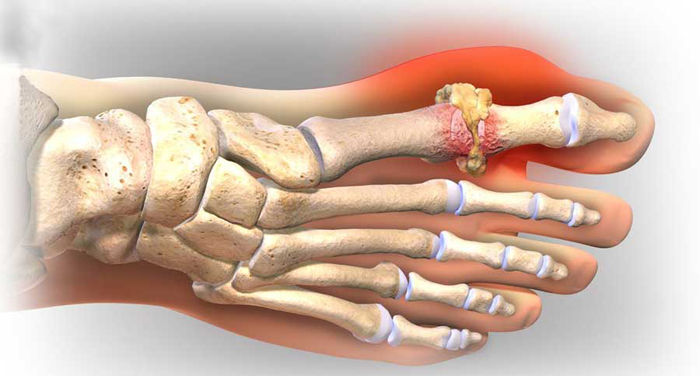 Người bị bệnh gout mạn tính có thể phát triển các tinh thể acid uric. 