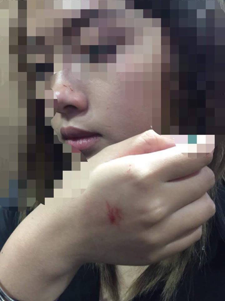 Hành vi tấn công của gã thanh niên đã để lại nhiều vết xước trên mặt và tay cô gái.