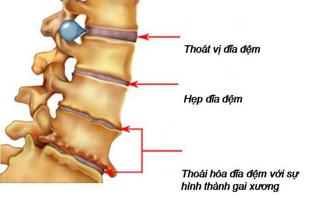 10 bệnh nguy hiểm bắt đầu từ nguyên nhân gây tê bàn tay