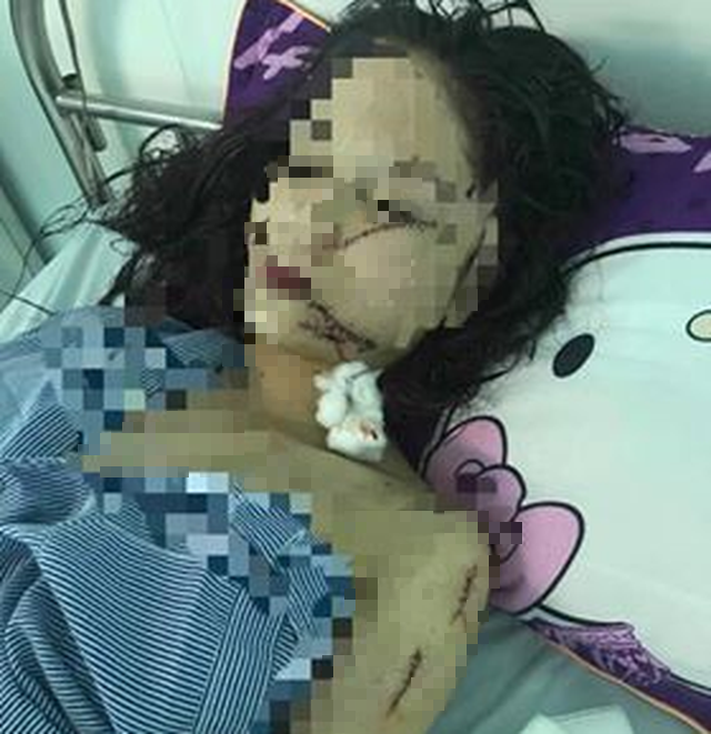 Cô gái 18 tuổi ở Bắc Ninh bị bạn rạch mặt, cổ và tay phải khâu 60 mũi 