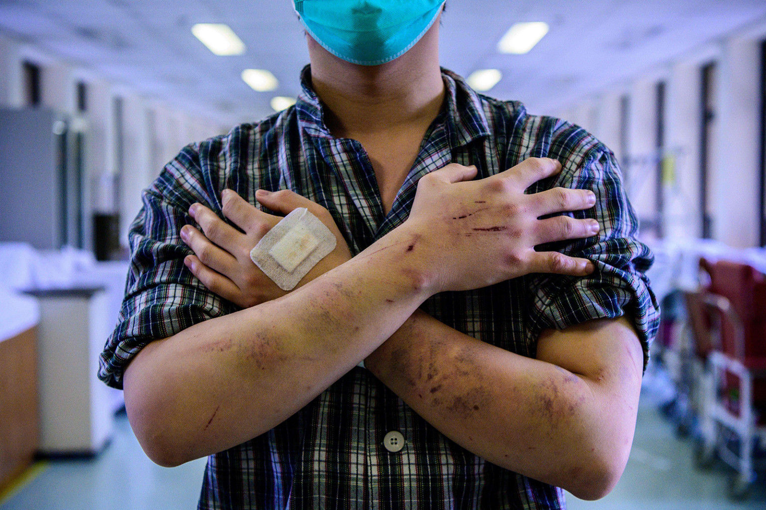 Calvin So, 23 tuổi, cư dân của thị trấn Yuen Long gần biên giới với Trung Quốc đại lục, cho thấy vết thương và vết bầm tím của anh ta ở hành lang bệnh viện ở Hồng Kông vào ngày 24 tháng 7, sau khi anh ta nói rằng anh ta bị tấn công trên đường đi làm về. các nhóm người đàn ông cũng tấn công người biểu tình trở về từ một cuộc tuần hành chống chính phủ khổng lồ vào ngày 21 tháng 7.