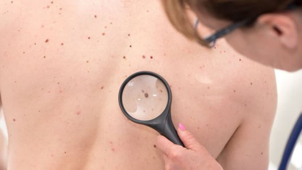 Tất tần tật về nốt ruồi trên cơ thể mà bạn nên biết để tránh bệnh ung thư da