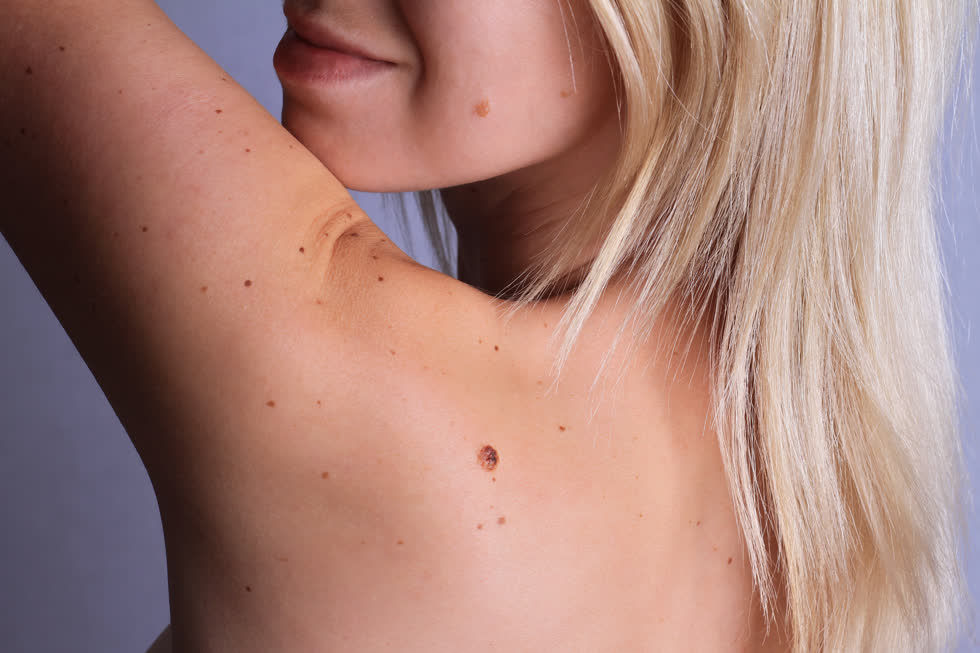 Tất tần tật về nốt ruồi trên cơ thể mà bạn nên biết để tránh bệnh ung thư da