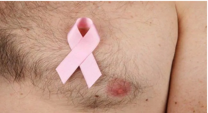 Tại sao nam giới lại mắc bệnh ung thư vú?