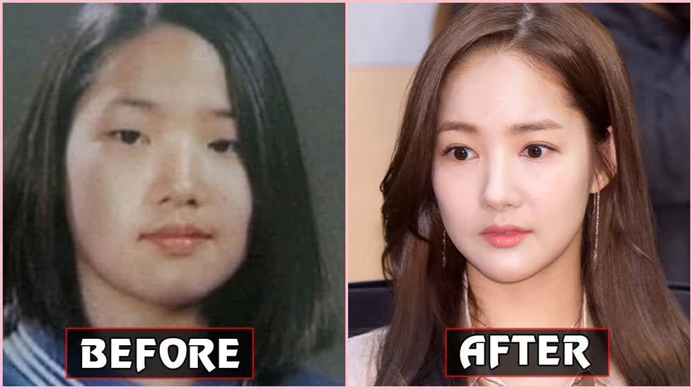 Park Min Young trước và sau khi phẫu thuật.