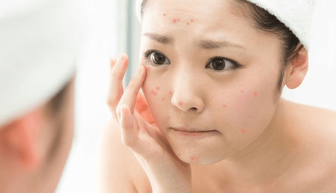 Chăm sóc da sau mụn đúng cách để ngăn ngừa sự xâm nhập của vi khuẩn, độc tố, bụi bẩn khi làn da đang bị tổn thương hở.