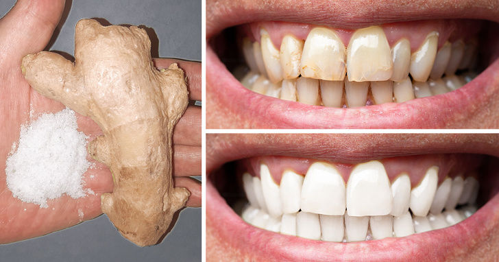 8 cách tự nhiên để làm cho răng trắng hơn tại nhà  