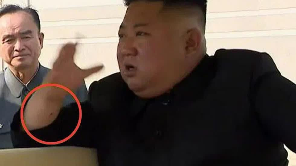 Theo Fox News, dấu vết này đã không xuất hiện trong buổi đi chơi công khai trước đó của ông Kim vào ngày 11/4.