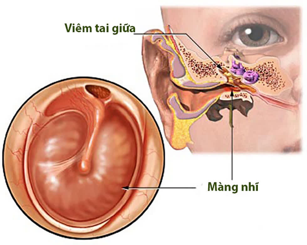   Theo bác sĩ Hoàng Lương, nếu bị viêm tai giữa mà không chữa trị kịp thời, sẽ dẫn đến nhiều biến chứng rất nguy hiểm không chỉ ở tai, mà nguy hiểm hơn là biến chứng đối với não.  