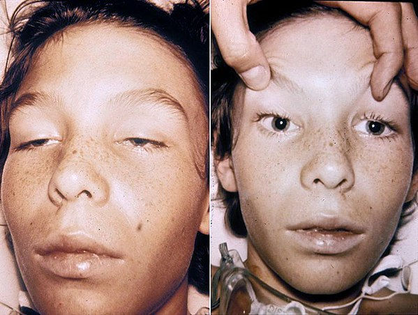 Một bệnh nhân 14 tuổi bị ngộ độc thịt. Khi đó, các cơ mắt bị yếu và sụp mí mắt trong hình trái, đồng tử nở rộng và không chuyển động ở hình phải và bệnh nhân này vẫn hoàn toàn tỉnh táo. Ảnh: Wikipedia