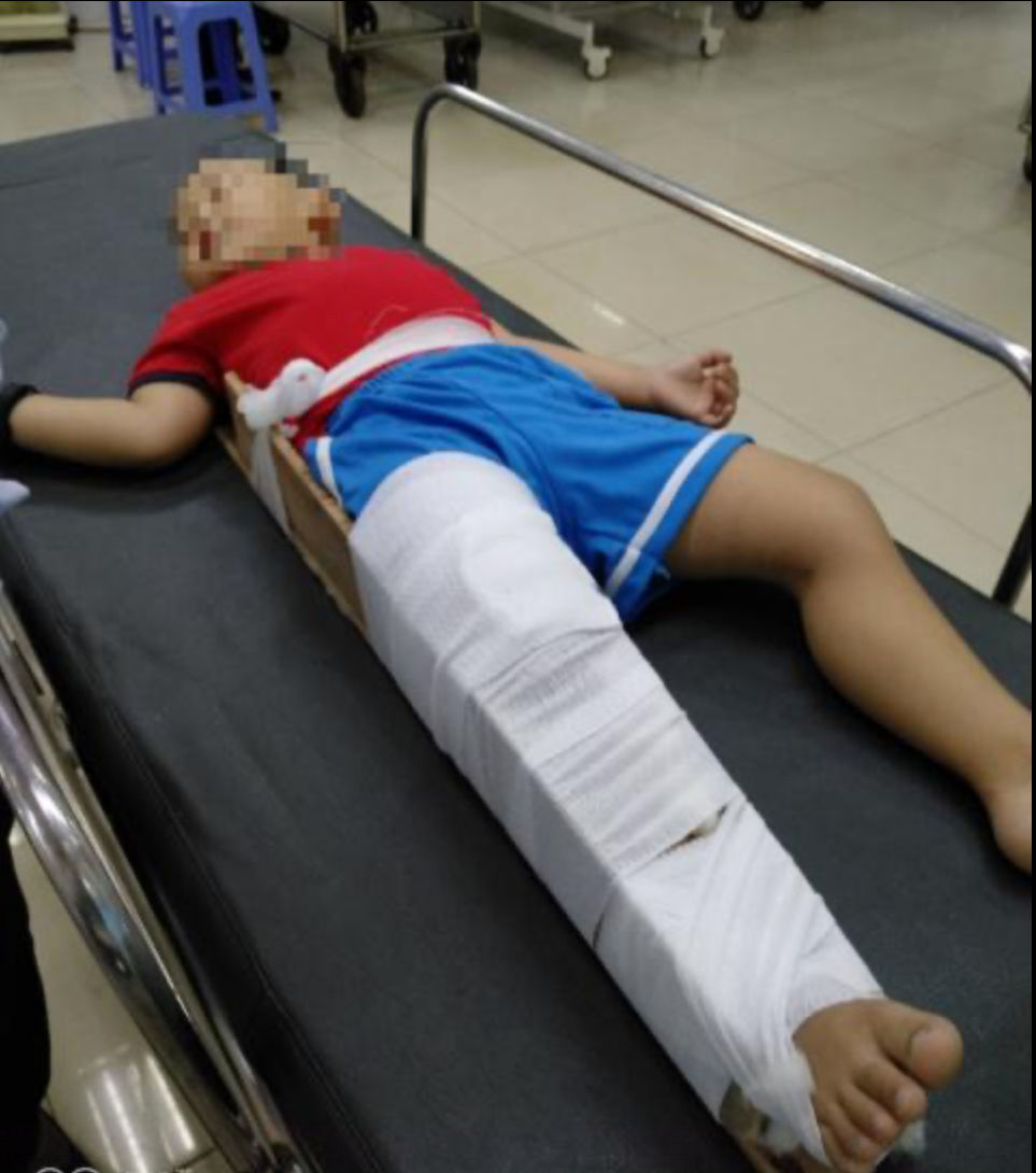 Bé P. đang điều trị tại bệnh viện Nhi Đồng 1 (TP.HCM). Ảnh: Dân Trí