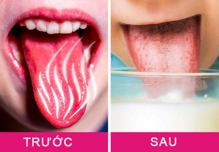 10 cách chữa lành vết bỏng lưỡi sau khi ăn đồ nóng 