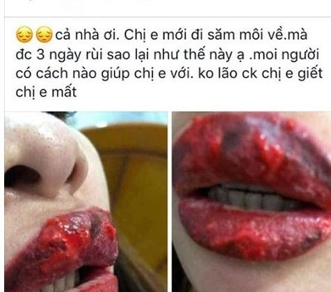 Một khách hàng xăm môi hỏng. 