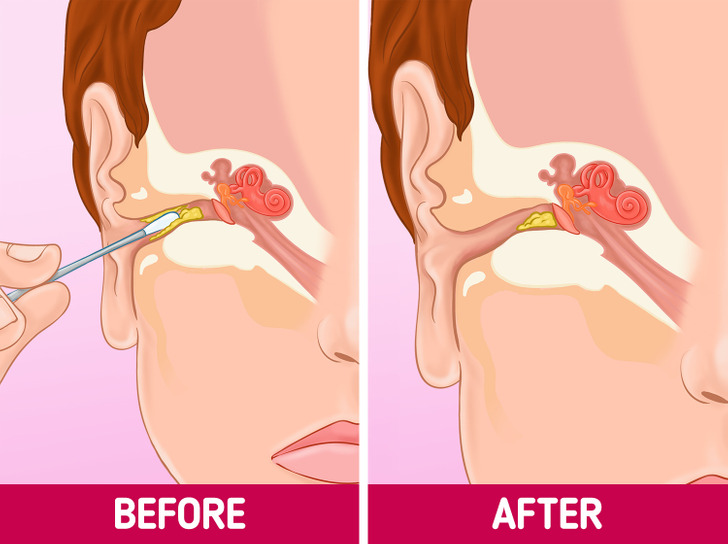 Tại sao bạn nên ngừng vệ sinh tai bằng tăm bông và cách để thay thế - Ảnh 2.