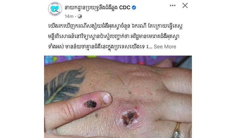 6 ca nghi nhiễm ở Campuchia không mắc đậu mùa khỉ - Ảnh 1.