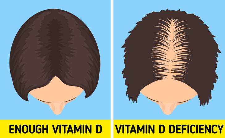 6 dấu hiệu cảnh báo bạn đang thiếu vitamin D - Ảnh 1.