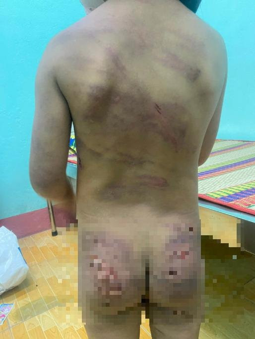 Bắt khẩn cấp cha dượng bạo hành bé gái 7 tuổi ở Bình Phước - Ảnh 2.