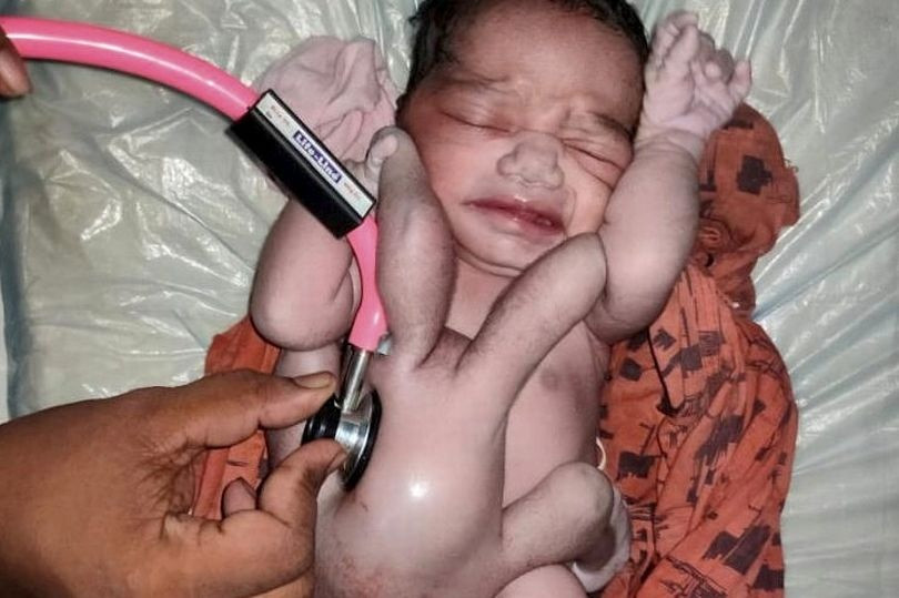 Em bé Ấn Độ sinh ra với 4 chân và 4 tay được ca ngợi một 'phép màu' và 'sự tái sinh của Chúa' - Ảnh 1. Em bé Ấn Độ sinh ra với 4 chân và 4 tay được ca ngợi một 'phép màu' và 'sự tái sinh của Chúa' - Ảnh 1.