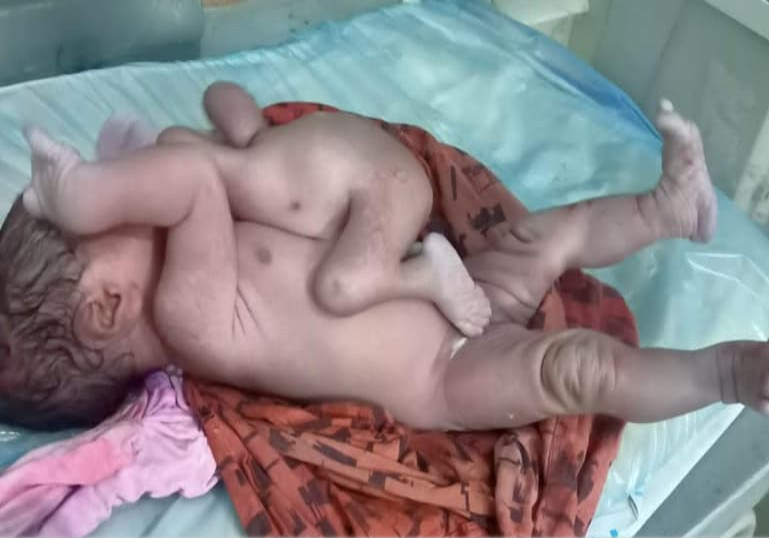 Em bé Ấn Độ sinh ra với 4 chân và 4 tay được ca ngợi một 'phép màu' và 'sự tái sinh của Chúa' - Ảnh 3.