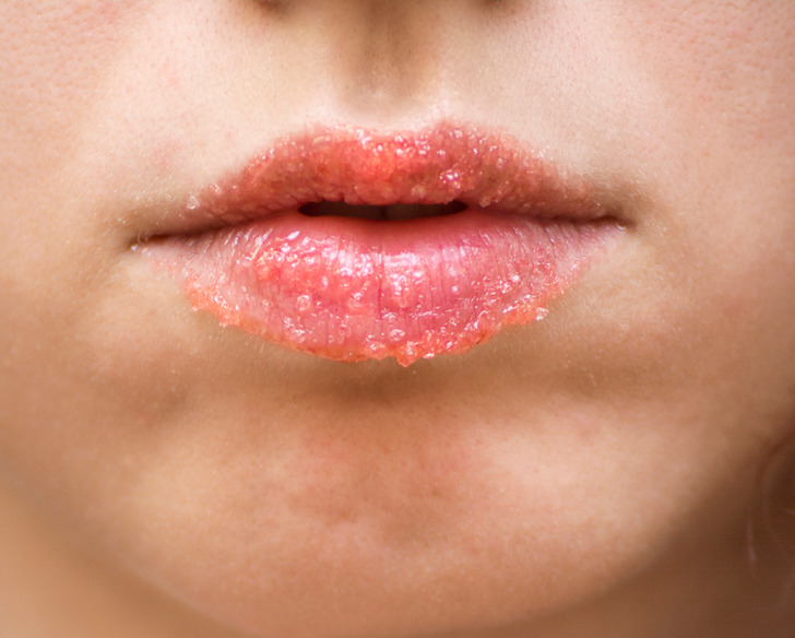 8 biện pháp khắc phục đôi môi khô nứt nẻ của bạn - Ảnh 7.
