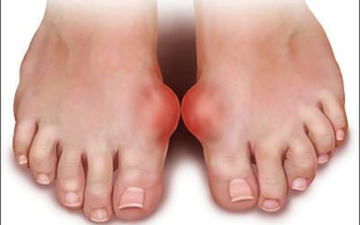 Đừng bỏ qua những dấu hiệu bất thường cảnh báo bệnh ở bàn chân này - Ảnh 4.
