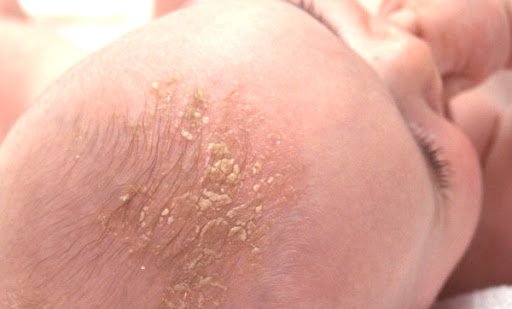  5 Bệnh ngoài da hay gặp ở trẻ mùa nắng nóng - Ảnh 5.