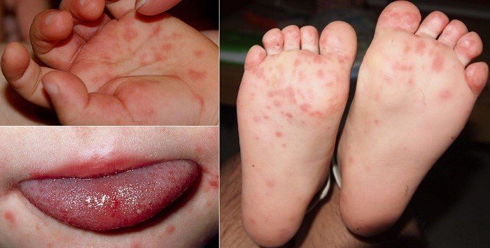  5 Bệnh ngoài da hay gặp ở trẻ mùa nắng nóng - Ảnh 4.