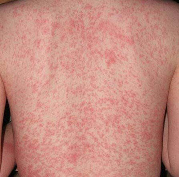  5 Bệnh ngoài da hay gặp ở trẻ mùa nắng nóng - Ảnh 1.