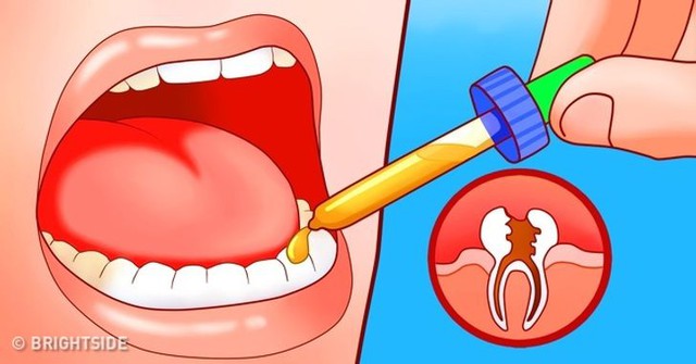Giảm đau răng khôn bằng 11 cách đơn giản - Ảnh 7.