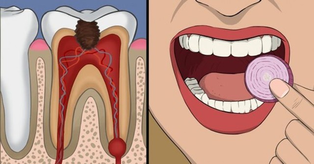 Giảm đau răng khôn bằng 11 cách đơn giản - Ảnh 11.