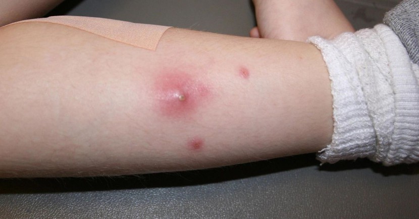  5 Bệnh ngoài da hay gặp ở trẻ mùa nắng nóng - Ảnh 3.