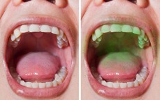 5 mẹo đơn giản để có được hơi thở thơm tho