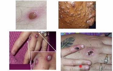 Người dân nên xét nghiệm đậu mùa khỉ nếu có triệu chứng nghi ngờ