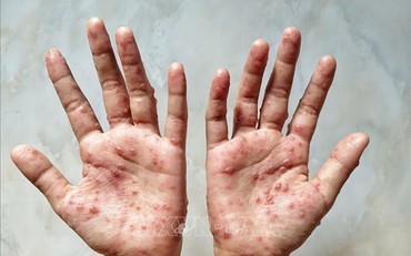 Brazil sử dụng thuốc kháng virus Tecovirimat điều trị bệnh nhân mắc đậu mùa khỉ nặng