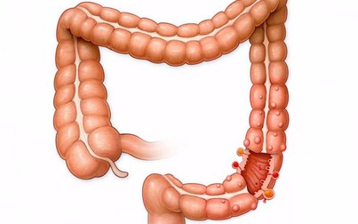 Phát hiện: Ruột thừa không hề thừa