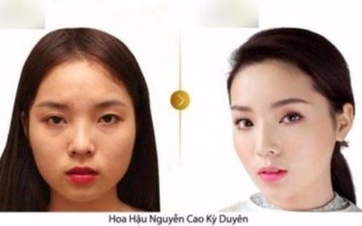 Hoa hậu Kỳ Duyên lại phẫu thuật thẩm mỹ dị thường?