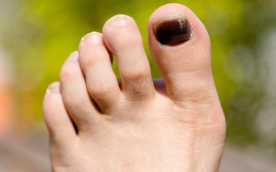 Nhiều căn bệnh đáng sợ được cảnh báo từ dấu hiệu đen móng chân