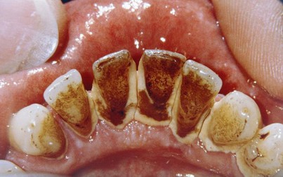 Đừng để bệnh răng miệng tăng nguy cơ ung thư: 4 cách đánh bật cao răng tại nhà