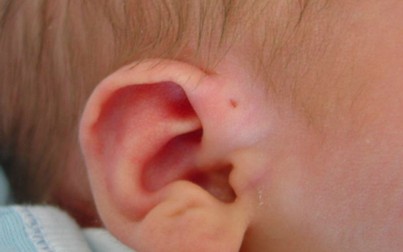 Mẹ cứ ngỡ con có lỗ nhỏ ở vành tai là thông minh nhưng sự thật lại rất nguy hiểm