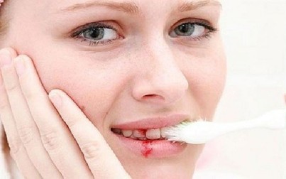 Chảy máu chân răng thường xuyên - dấu hiệu của căn bệnh ung thư nguy hiểm