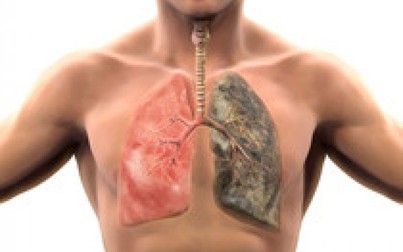 Năm thói quen gây hại phổi nhiều người mắc phải