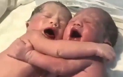 Kì lạ cặp song sinh vừa khóc vừa ôm chặt nhau khi chào đời