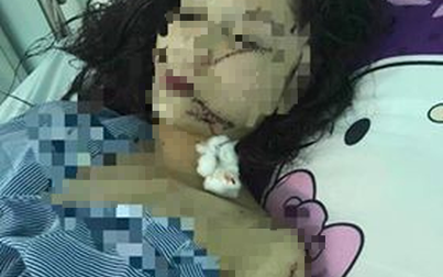 Cô gái 18 tuổi ở Bắc Ninh bị bạn rạch mặt, cổ và tay phải khâu 60 mũi